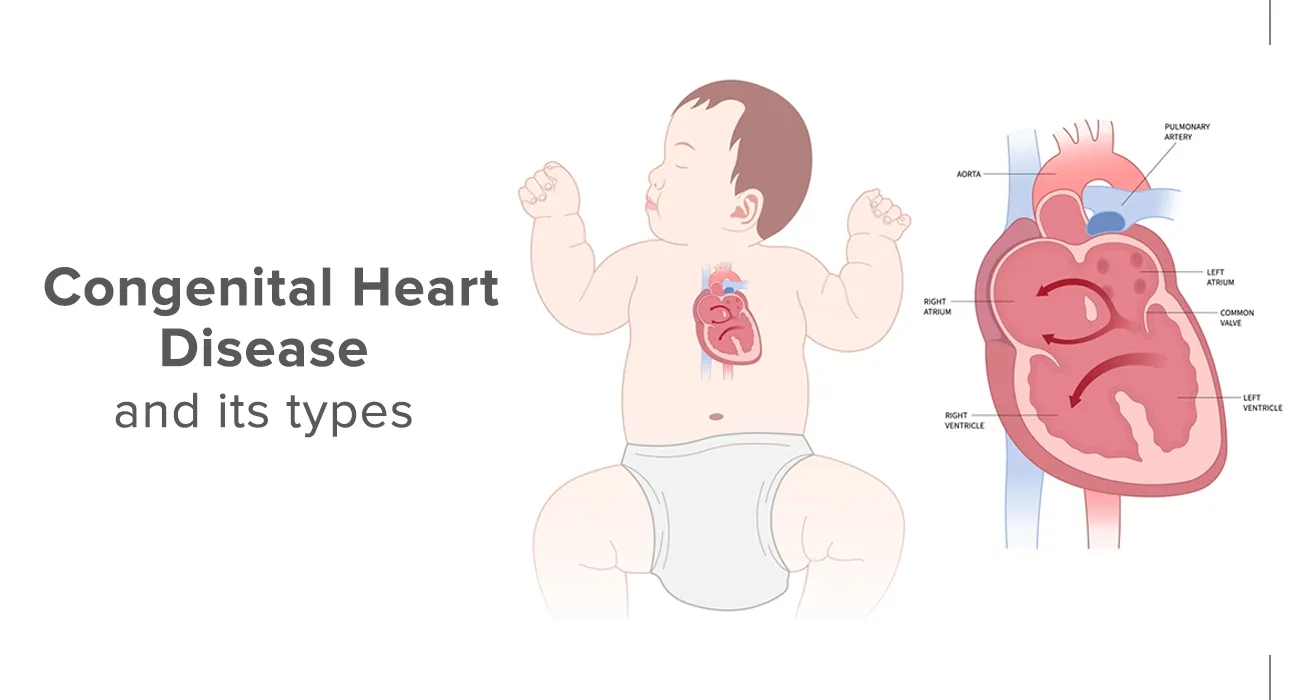 Congenital Heart Disease Treatment image 1