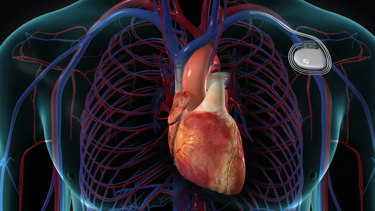 Pacemaker Treatment image 1