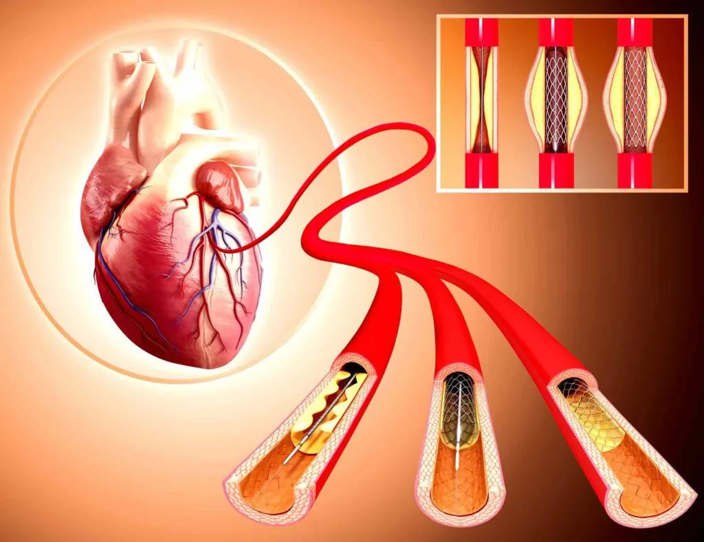 Angiography Treatment image 1