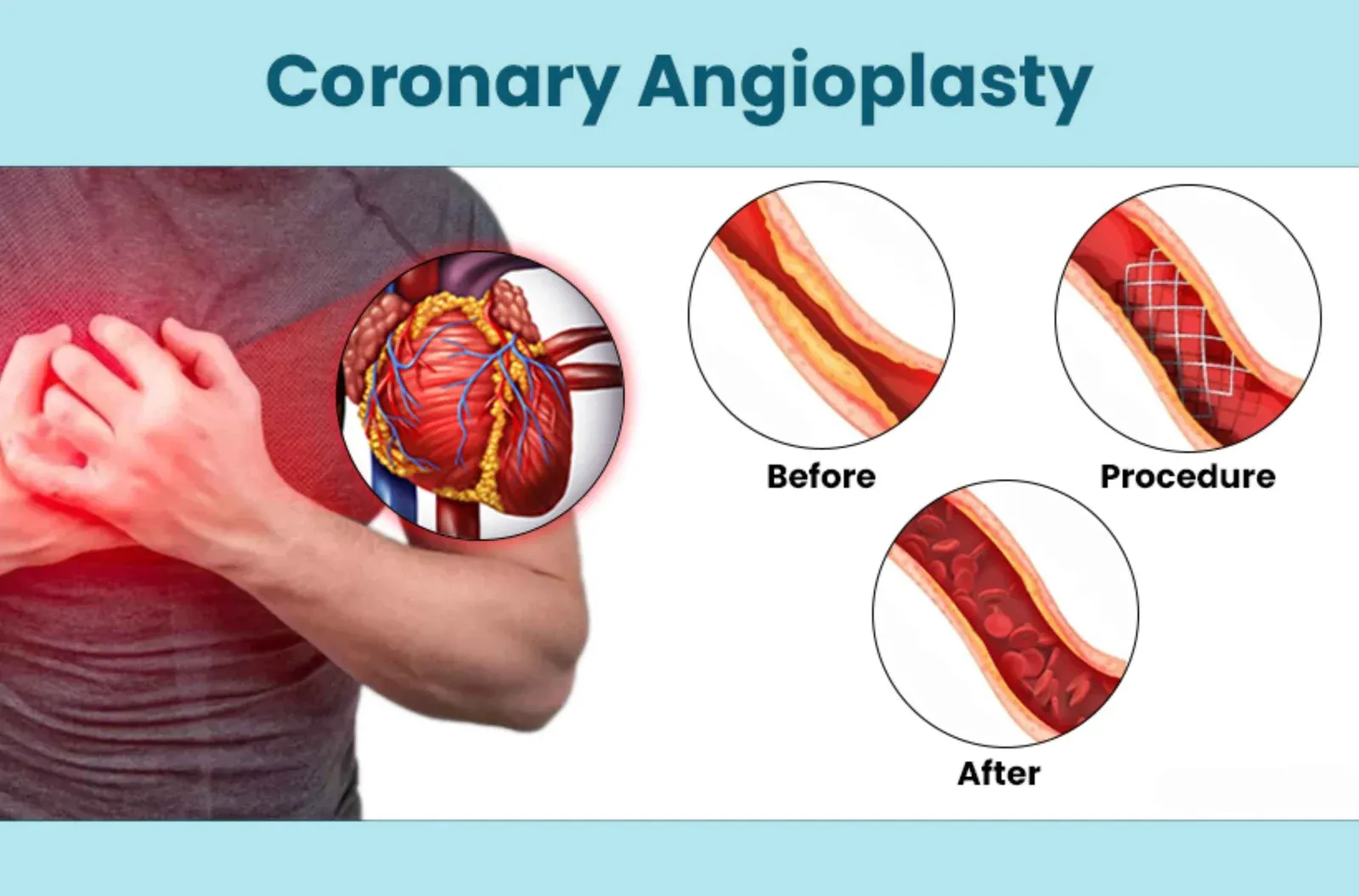 Angioplasty Treatment image 1