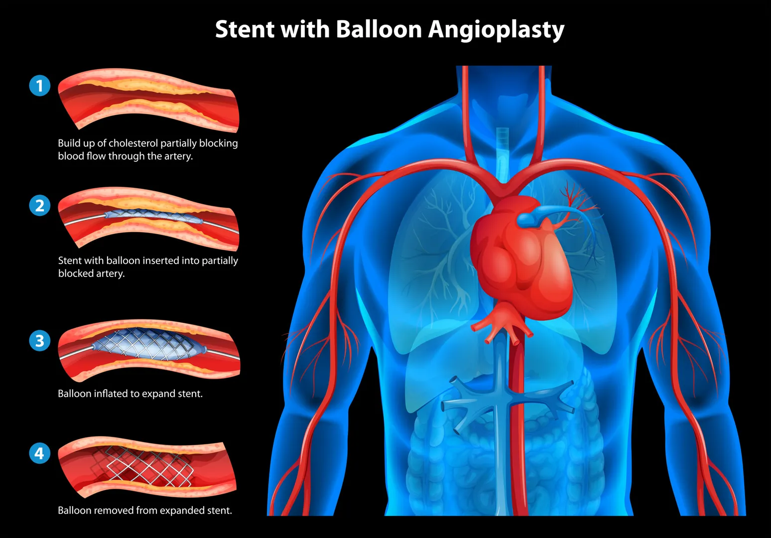 Stent Placement Treatment image 1