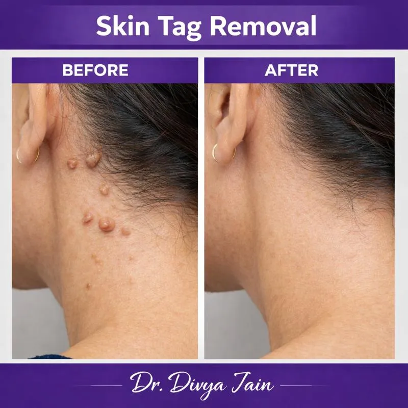 Skin Tag Removal image 1