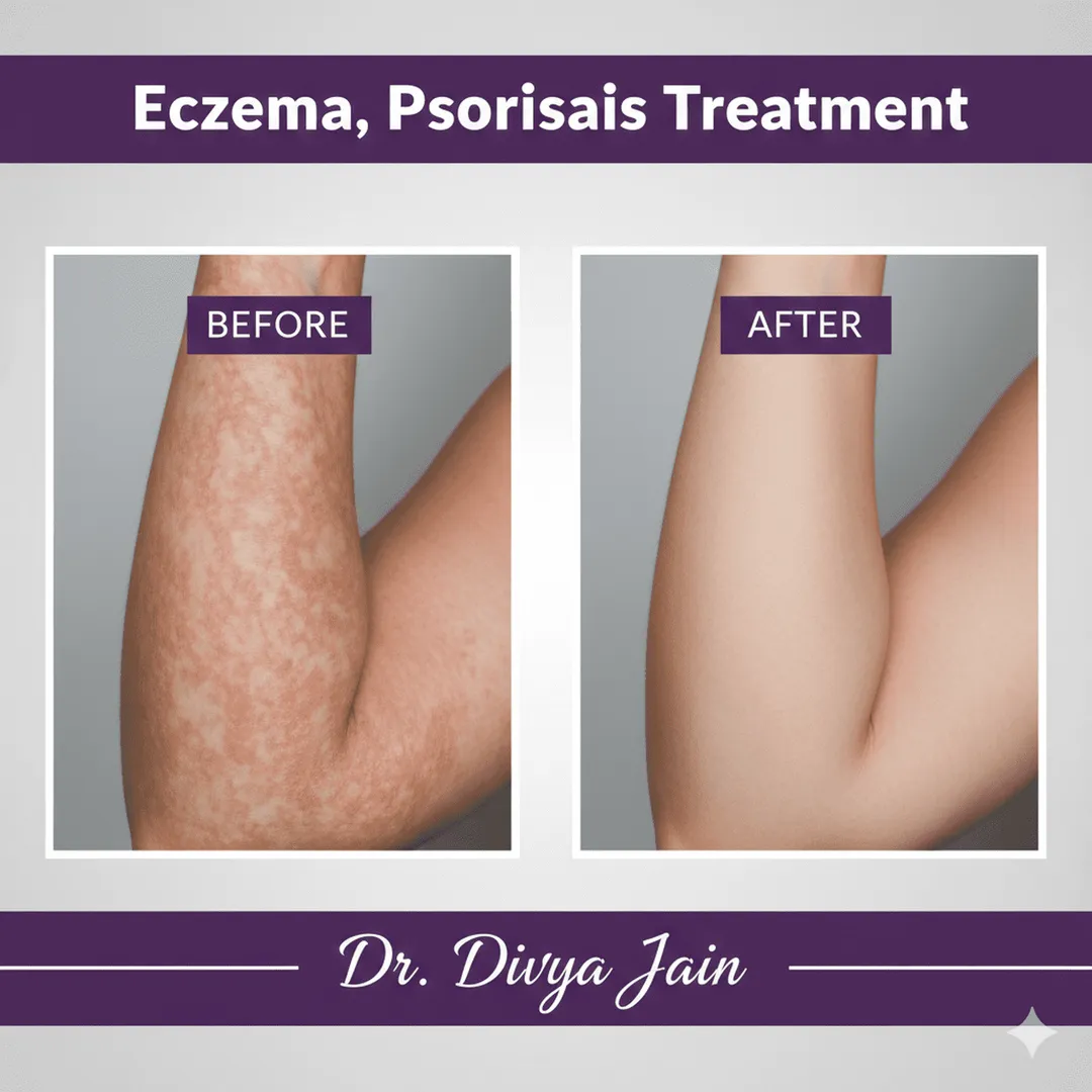 Eczema, Psoriasis image 1