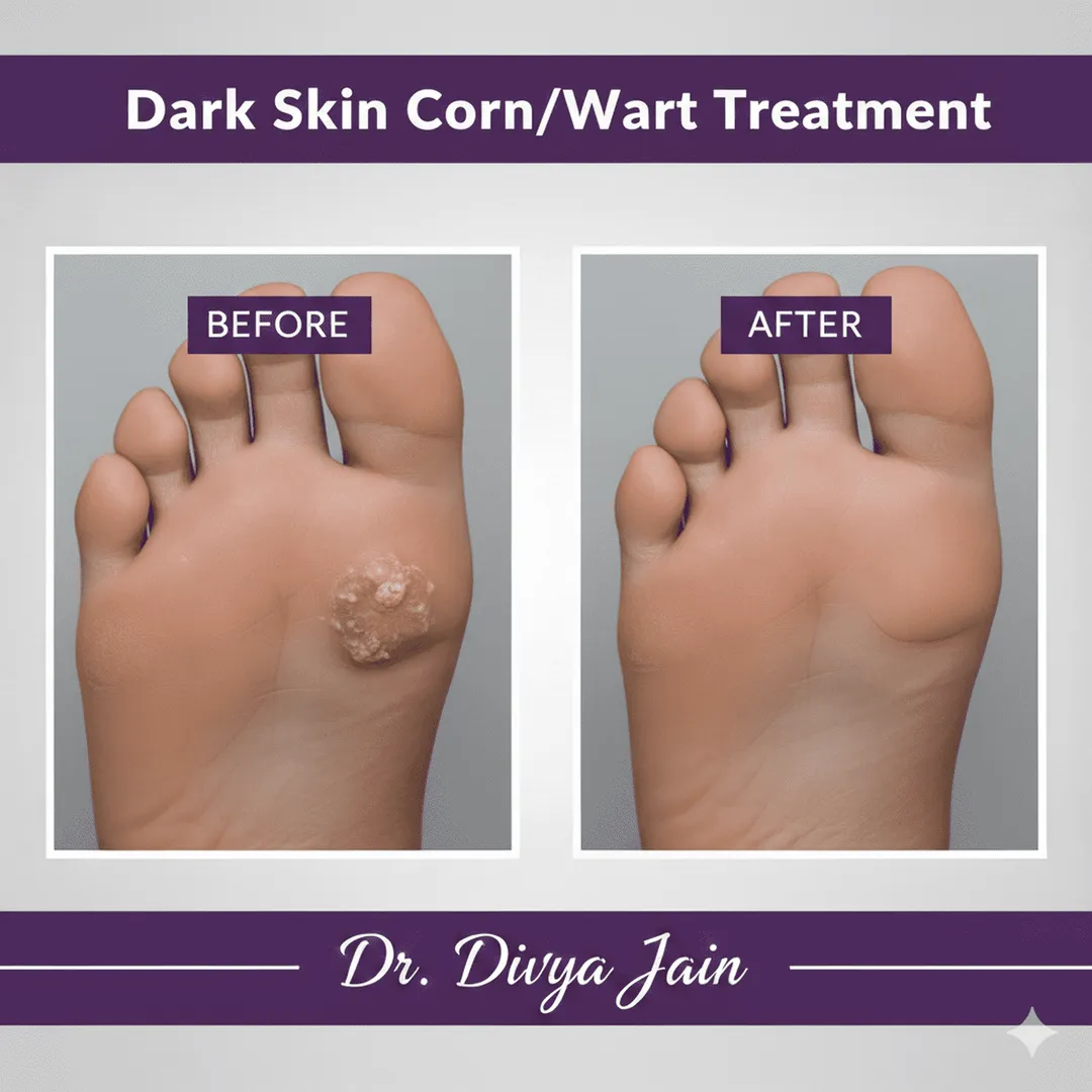 Dark Skin Corn/Wart image 1