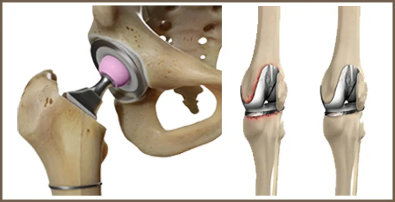 Knee And Hip Replacement Surgery   image 1