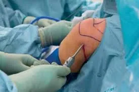 shoulder Arthroscopy surgery image 1