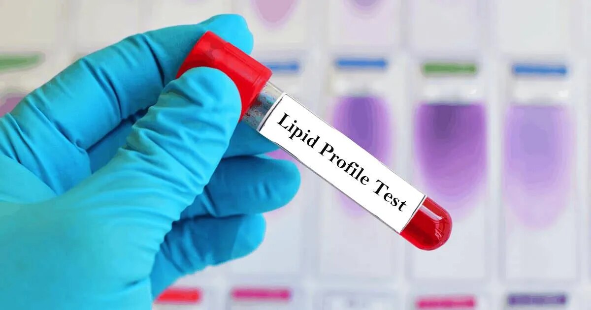 Lipid Profile (Cholesterol Test) image 2