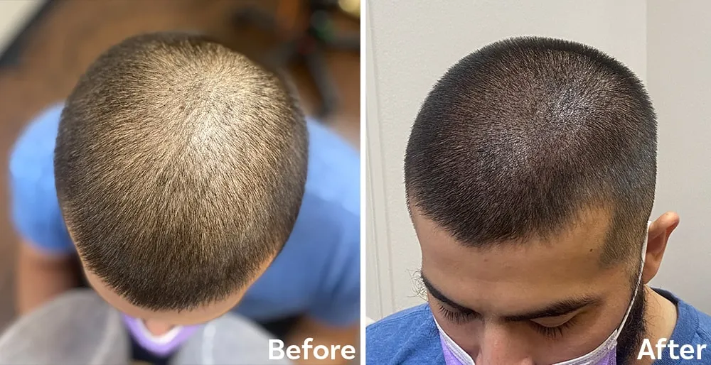 Scalp Micropigmentation (SMP) Treatment image 1