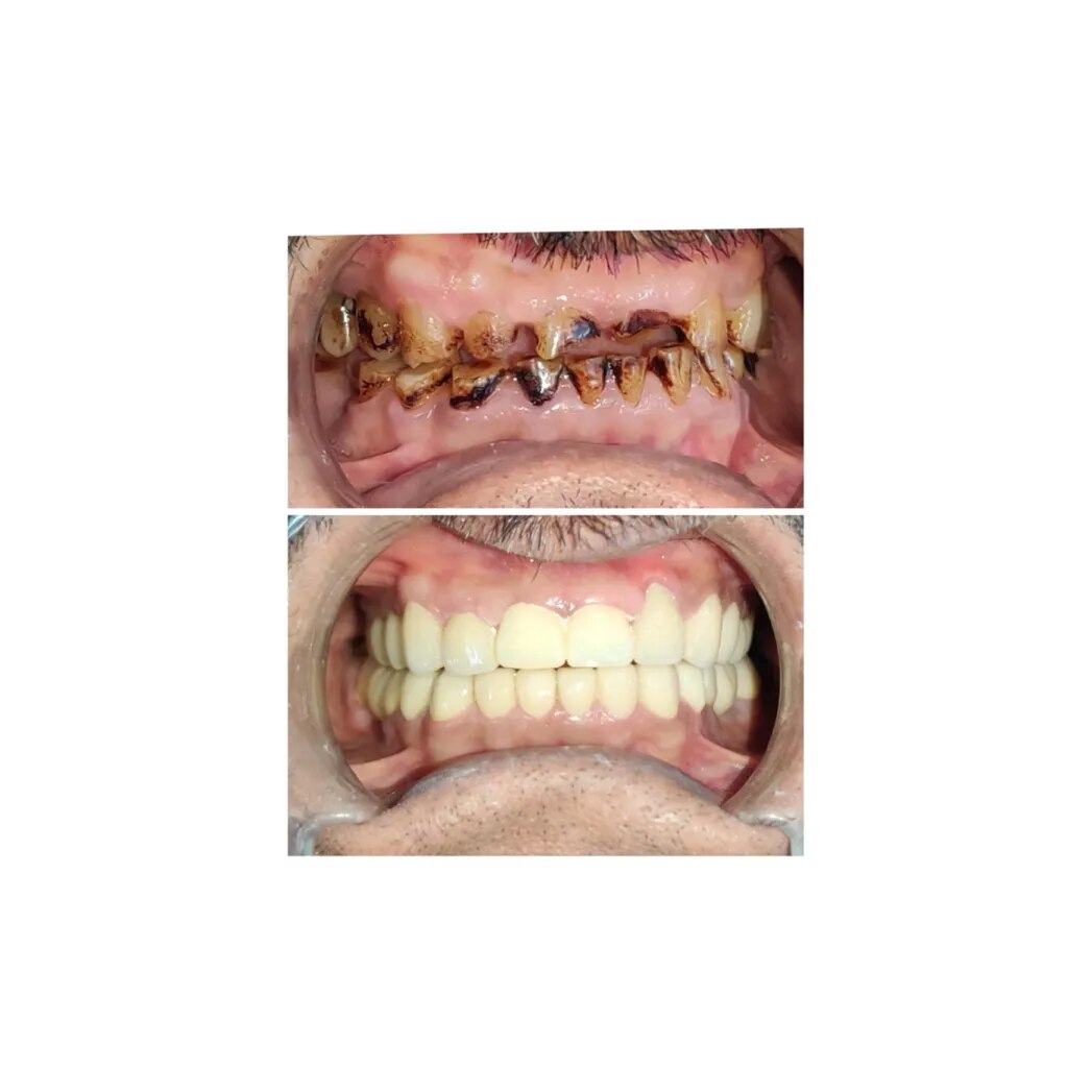 Full Mouth Rehabilitation  image 1