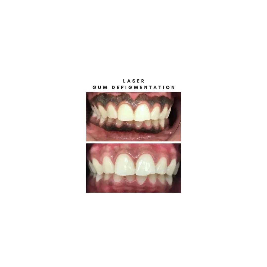 Laser Depigmentation Of Gingiva  image 1