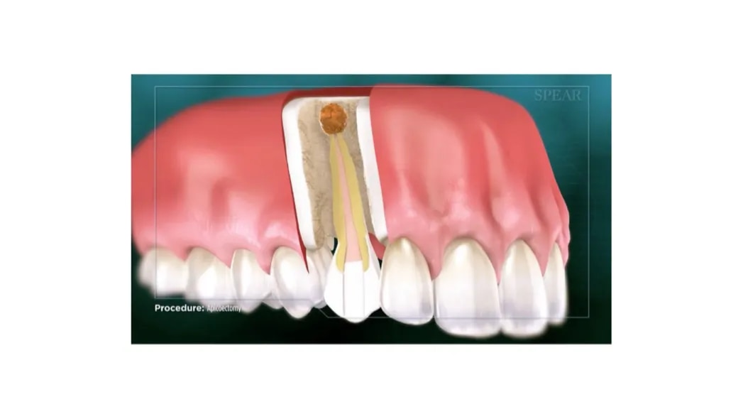 Apicoectomy image 1