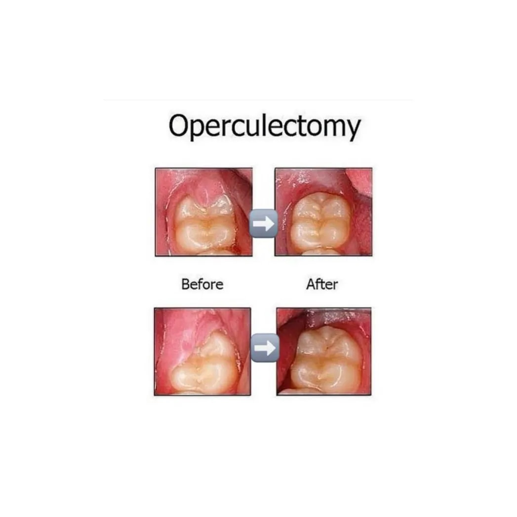 Laser Operculectomy image 1