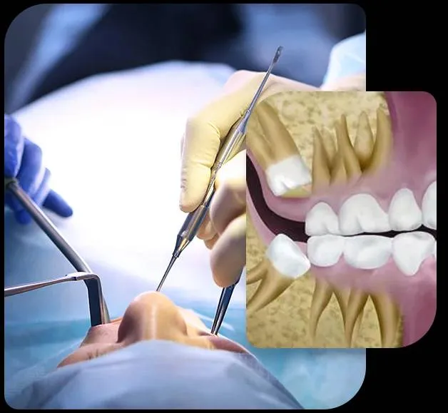 Wisdom Tooth Surgeries image 1