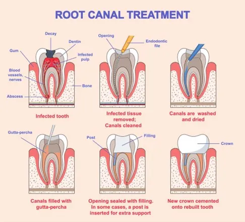 Root Canal Treatment image 1