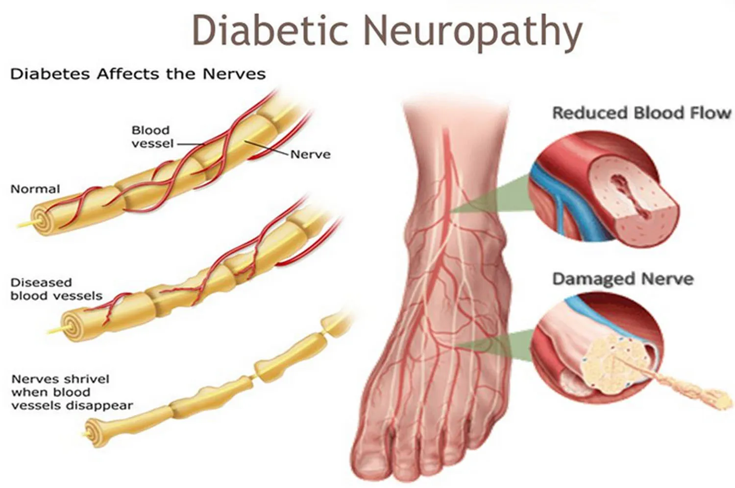 Diabetic Neuropathy Treatment image 1