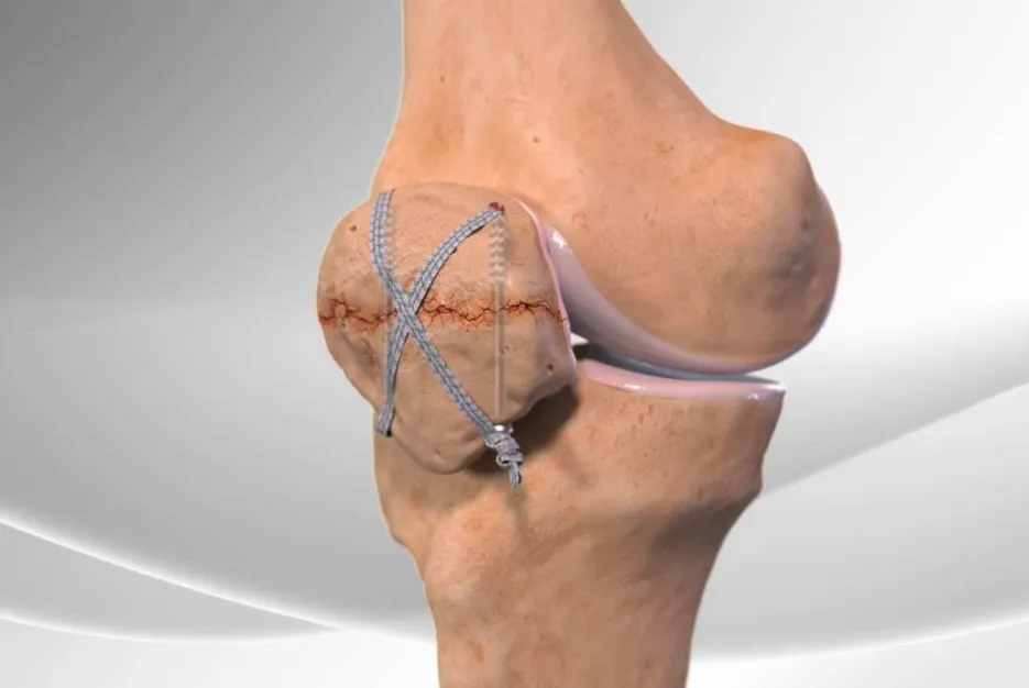 Patella Fracture Treatment image 1
