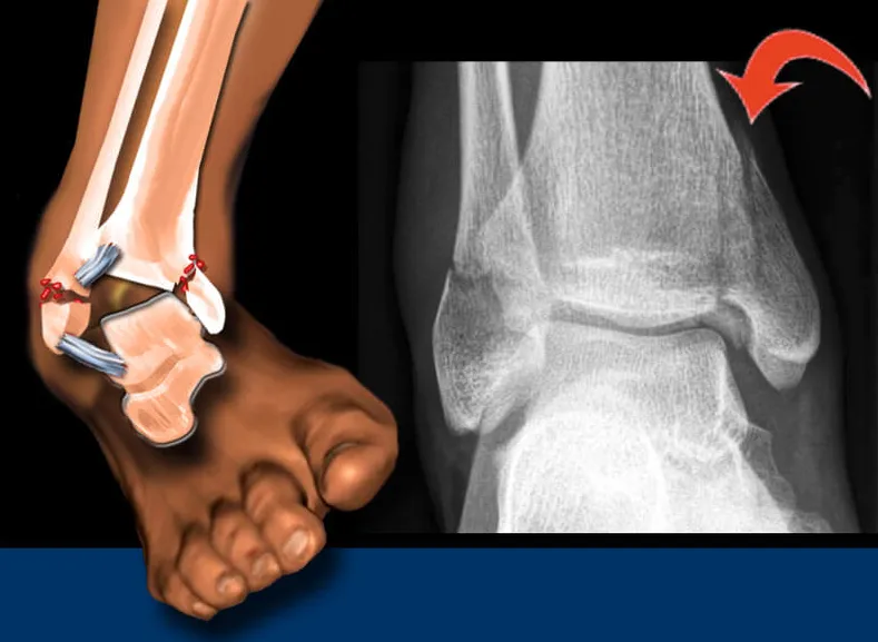 Ankle Fracture Treatment image 1