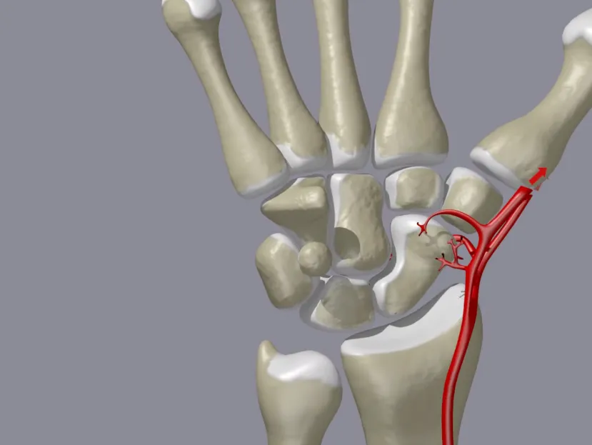 Scaphoid Fracture Treatment image 1