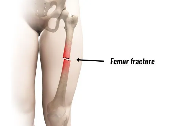 Femur Fracture Treatment image 1
