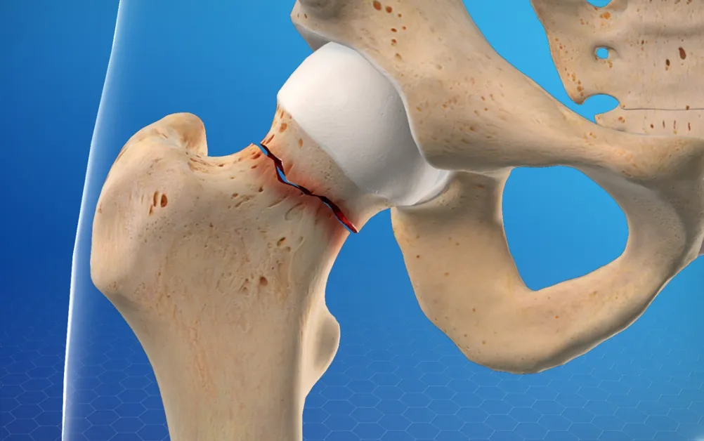 Hip Fracture Treatment image 1