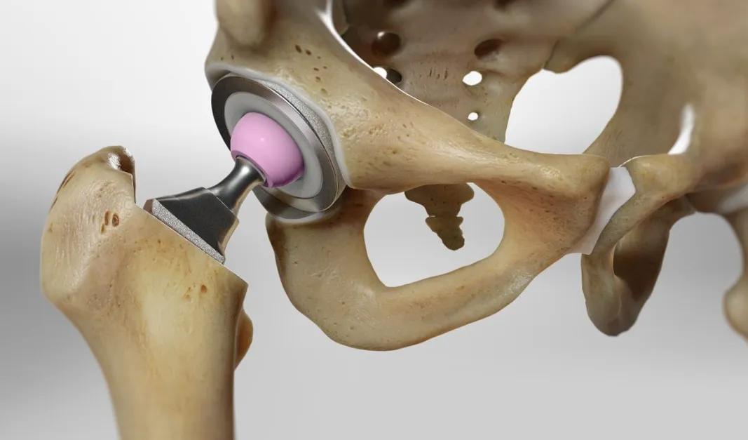 Total Hip Replacement image 1