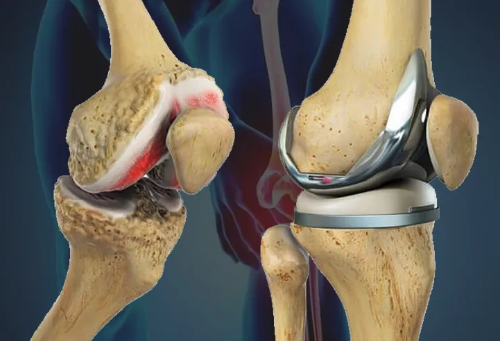 Total Knee Replacement image 1