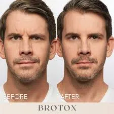 Bro-tox  image 1