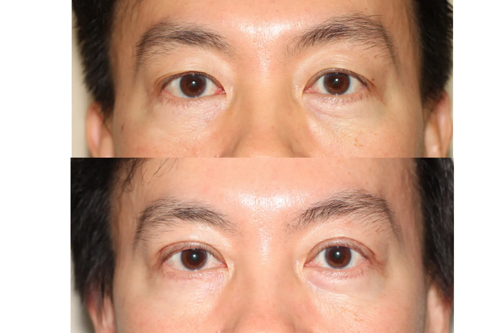 Eyelid Surgery (Blepharoplasty) image 1