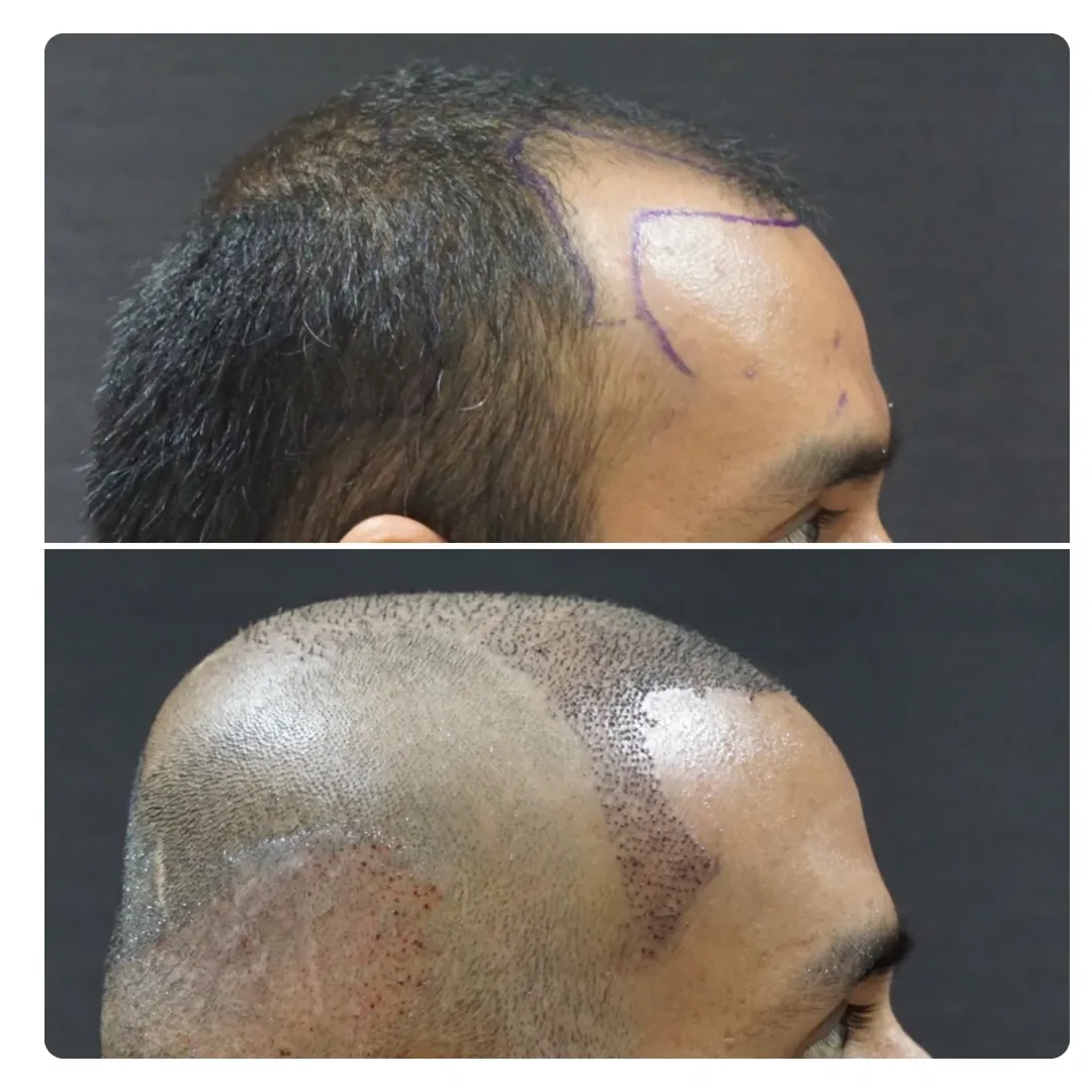 Hair Transplant image 1
