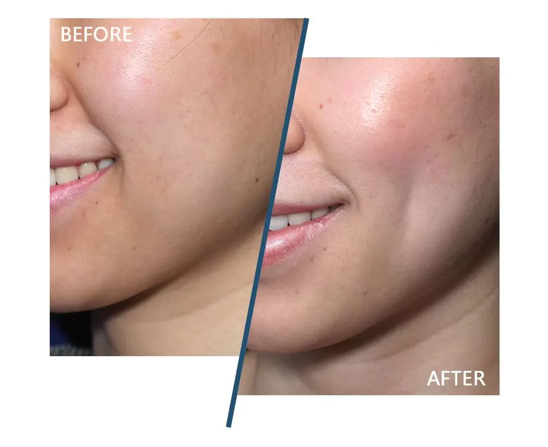 Dimple Creation Surgery image 1