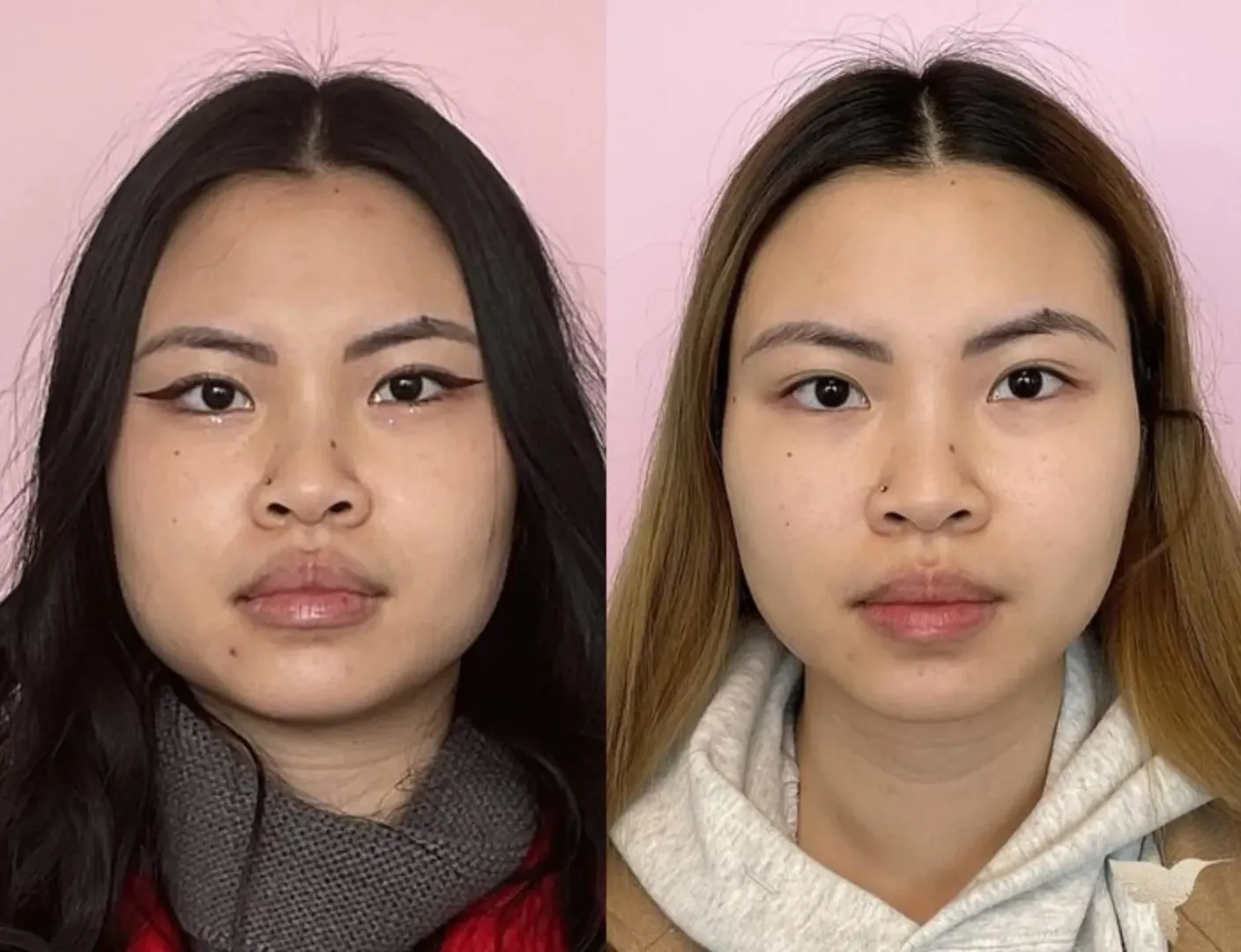 Face Slimming Surgery image 1