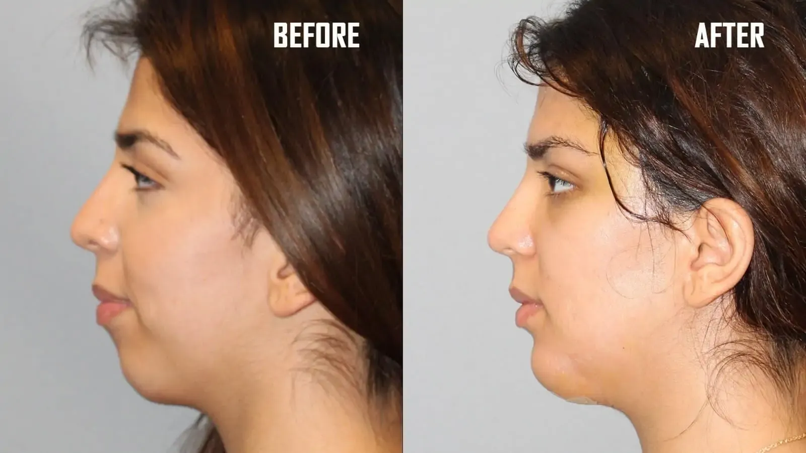 Chin Augmentation  image 1