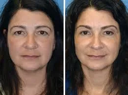 Brow Lift Surgery image 1