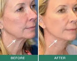 Neck Lift Surgery image 1