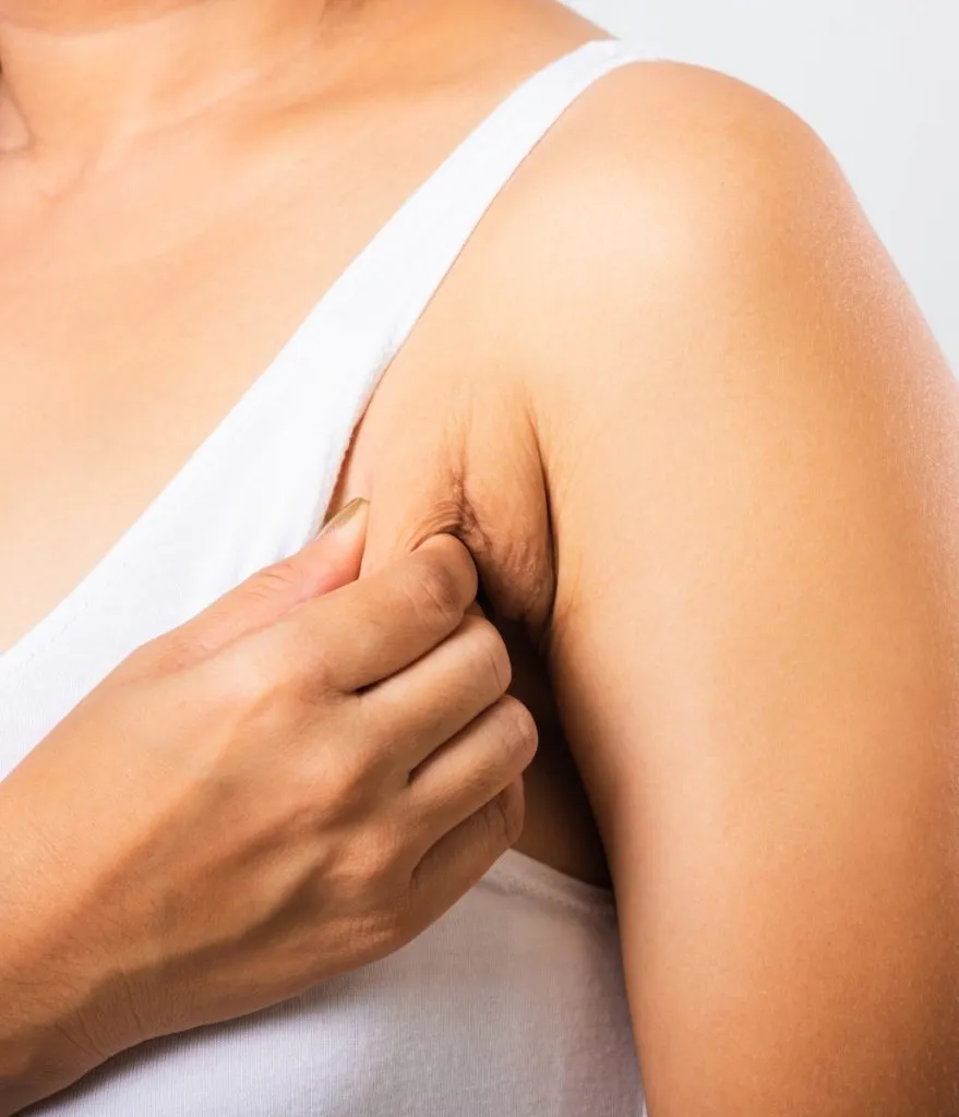 Axillary Breast (Underarm Breast) Treatment image 1