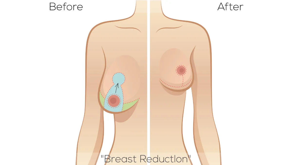 Breast Reduction Surgery image 1