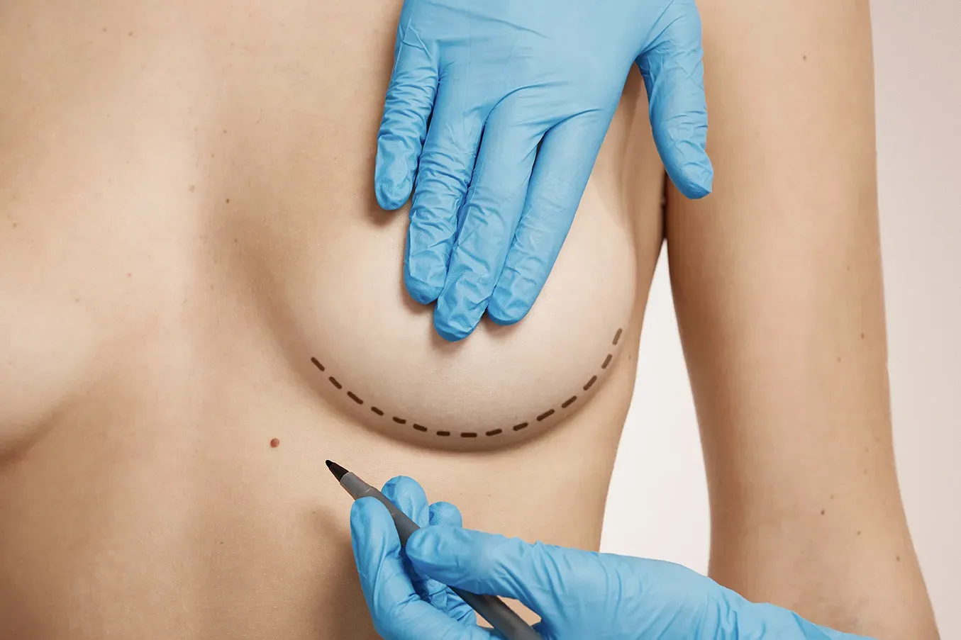 Breast Lift (Mastopexy) image 1