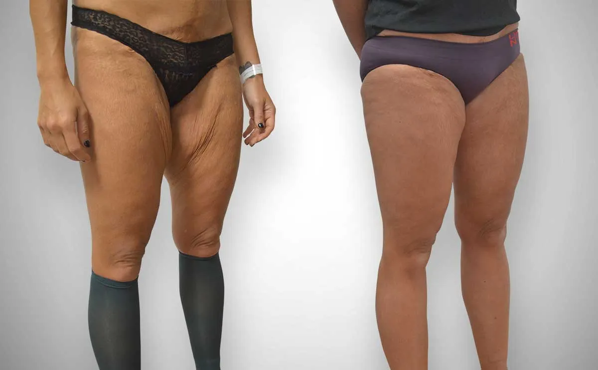 Thigh Lift Surgery image 1