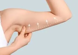 Arm Lift (Brachioplasty) image 1