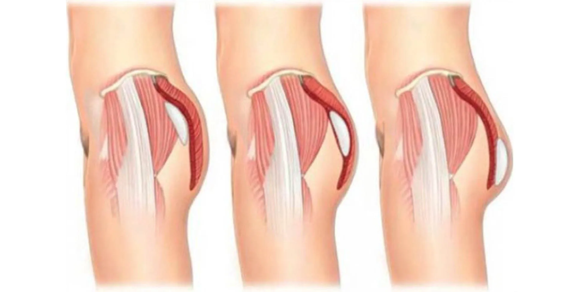 Buttock Augmentation image 1