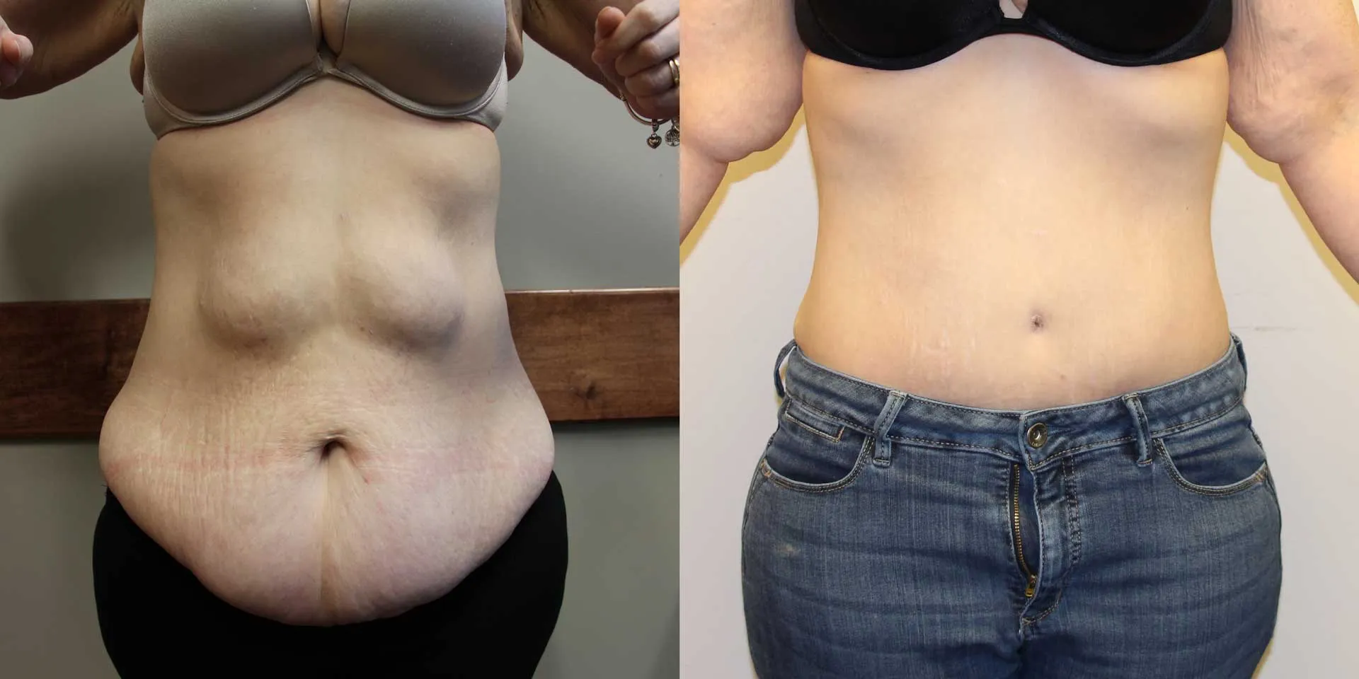Tummy Tuck (Abdominoplasty) image 1