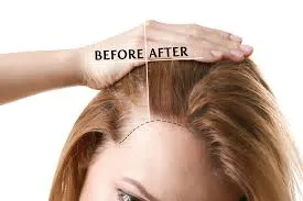 Hair Fall Treatment image 1