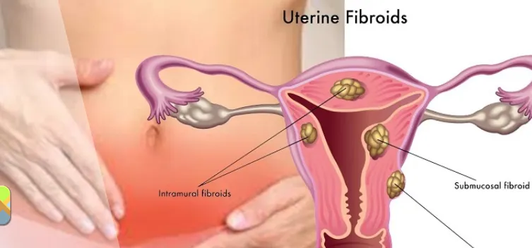 Fibroids Treatment  image 1