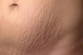 stretch marks treatment image 1