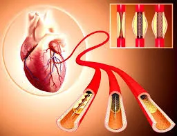 Coronary Angiography & Angioplasty image 1