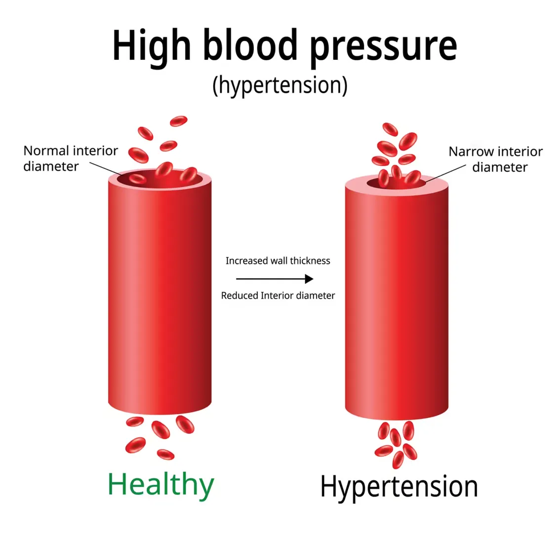 High Blood Pressure (Hypertension) Treatment image 1