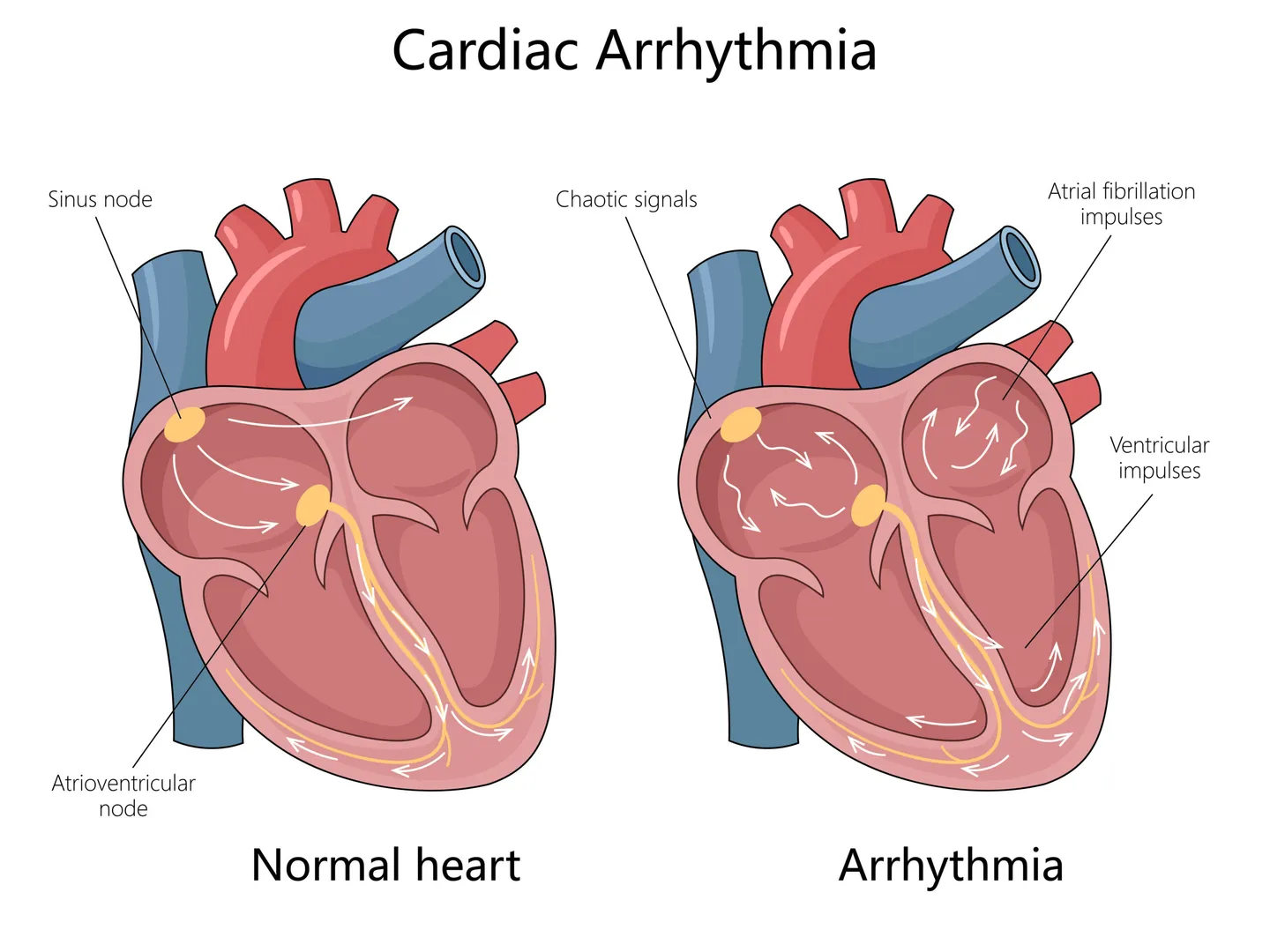 Palpitations / Arrhythmias image 1