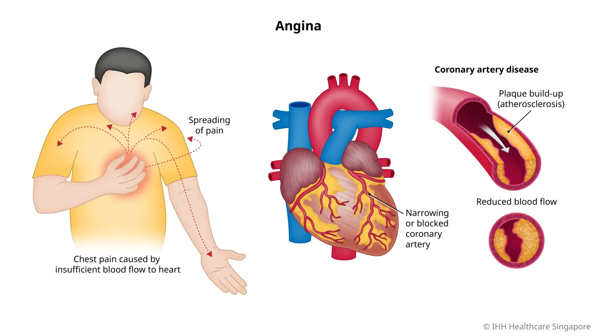 Chest Pain / Angina Treatment image 1