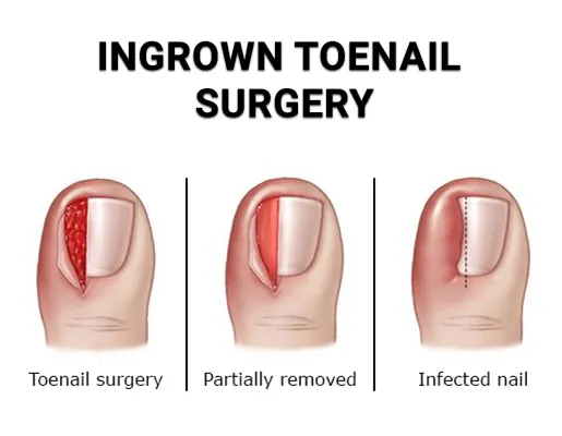 Ingrown toenail removal image 1