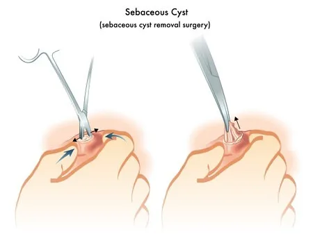 Cyst Excision surgery image 1